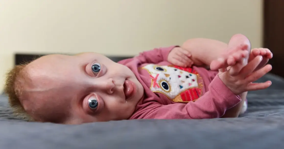 Niemowlę z zespołem Pfeiffera, z szeroko otwartymi niebieskimi oczami i wystawionym językiem, leży na szarym kocu.